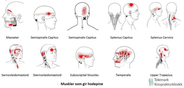 Akutt stiv nakke Akutt stiv nakke